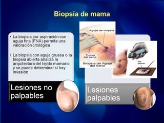 Biopsia de mama
 