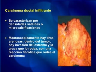 Carcinoma ductal infiltrante
• Se caracterizan por
densidades satélites o
microcalcificaciones
• Macroscopicamente hay tiras
arenosas, dentro del tumor,
hay invasión del estroma y la
grasa que lo rodea, con una
reacción fibrotica que rodea el
carcinoma
 