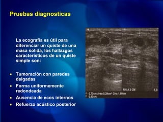 Pruebas diagnosticas
La ecografía es útil para
diferenciar un quiste de una
masa solida, los hallazgos
característicos de un quiste
simple son:
• Tumoración con paredes
delgadas
• Forma uniformemente
redondeada
• Ausencia de ecos internos
• Refuerzo acústico posterior
 