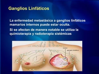 Ganglios Linfáticos
La enfermedad metastásica a ganglios linfáticos
mamarios internos puede estar oculta.
Si se afectan de manera notable se utiliza la
quimioterapia y radioterapia sistémicas
 