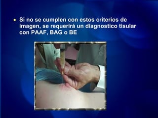 • Si no se cumplen con estos criterios de
imagen, se requerirá un diagnostico tisular
con PAAF, BAG o BE
 