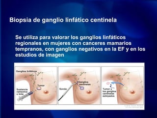 Biopsia de ganglio linfático centinela
Se utiliza para valorar los ganglios linfáticos
regionales en mujeres con canceres mamarios
tempranos, con ganglios negativos en la EF y en los
estudios de imagen
 