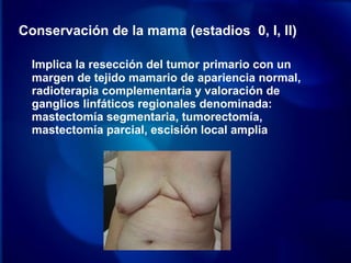 Conservación de la mama (estadios 0, I, II)
Implica la resección del tumor primario con un
margen de tejido mamario de apariencia normal,
radioterapia complementaria y valoración de
ganglios linfáticos regionales denominada:
mastectomía segmentaria, tumorectomía,
mastectomía parcial, escisión local amplia
 