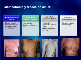 Mastectomía y disección axilar
 