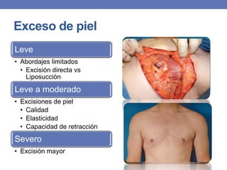 Exceso de piel
Leve
• Abordajes limitados
  • Excisión directa vs
    Liposucción
Leve a moderado
• Excisiones de piel
  • Calidad
  • Elasticidad
  • Capacidad de retracción
Severo
• Excisión mayor
 