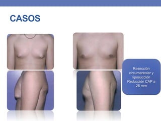 CASOS




             Resección
         circumareolar y
            liposucción
        Reducción CAP a
               25 mm
 