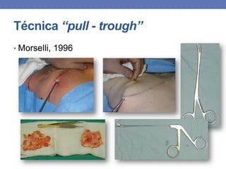 Técnica “pull - trough”
• Morselli, 1996
 