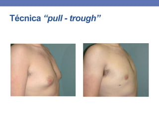 Técnica “pull - trough”
 