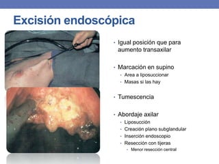 Excisión endoscópica
                • Igual posición que para
                 aumento transaxilar

                • Marcación en supino
                  • Area a liposuccionar
                  • Masas si las hay


                • Tumescencia


                • Abordaje axilar
                  • Liposucción
                  • Creación plano subglandular
                  • Inserción endoscopio
                  • Resección con tijeras
                    • Menor resección central
 