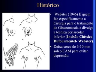 Histórico
• Webster (1946) É quem
faz especificamente a
Cirurgia para o tratamento
de Ginecomastia e divulga
a técnica periareolar
inferior (Incisão Clássica
Dufourmentel- Webster).
• Deixa cerca de 6-10 mm
sob o CAM para evitar
depressão.
 