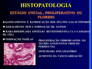 HISTOPATOLOGIA
ESTÁGIO INICIAL , PROLIFERATIVO OU
FLORIDO
ALONGAMENTO E RAMIFICAÇÃO DOS DUCTOS GALACTÓFOROS
 GERALMENTE SEM A FORMAÇÃO DE ÁCINOS
 RARA HIPERPLASIA EPITÉLIO REVESTIMENTO ( 3 A 4 CAMADAS
DE CÉL)
 FORMAÇÃO PAPILAS PROLIFERAÇÃO FIBROBLASTOS NO
TECIDO CONJUNTIVO FROUXO
PERIDUCTAL
INFILTRADO INFLAMATÓRIO
AUMENTO DA VASCULARIZAÇÃO
 