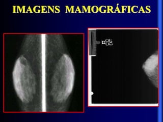 IMAGENS MAMOGRÁFICAS
 