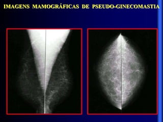 IMAGENS MAMOGRÁFICAS DE PSEUDO-GINECOMASTIA
 