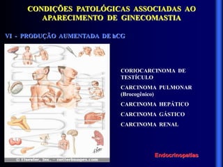 CONDIÇÕES PATOLÓGICAS ASSOCIADAS AO
APARECIMENTO DE GINECOMASTIA
VI - PRODUÇÃO AUMENTADA DE hCG
CORIOCARCINOMA DE
TESTÍCULO
CARCINOMA PULMONAR
(Brocogênico)
CARCINOMA HEPÁTICO
CARCINOMA GÁSTICO
CARCINOMA RENAL
Endocrinopatias
 