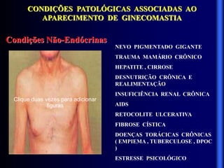 CONDIÇÕES PATOLÓGICAS ASSOCIADAS AO
APARECIMENTO DE GINECOMASTIA
Condições Não-Endócrinas
NEVO PIGMENTADO GIGANTE
TRAUMA MAMÁRIO CRÔNICO
HEPATITE , CIRROSE
DESNUTRIÇÃO CRÔNICA E
REALIMENTAÇÃO
INSUFICIÊNCIA RENAL CRÔNICA
AIDS
RETOCOLITE ULCERATIVA
FIBROSE CÍSTICA
DOENÇAS TORÁCICAS CRÔNICAS
( EMPIEMA , TUBERCULOSE , DPOC
)
ESTRESSE PSICOLÓGICO
Clique duas vezes para adicionar
figuras
 