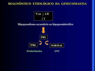 DIAGNÓSTICO ETIOLÓGICO DA GINECOMASTIA
N ou LH
T
Hipogonadismo secundário ou hipogonadotrófico
PRL
PRL NORMAL
Prolactinoma SNC
 