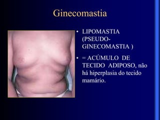 Ginecomastia
• LIPOMASTIA
(PSEUDO-
GINECOMASTIA )
• = ACÚMULO DE
TECIDO ADIPOSO, não
há hiperplasia do tecido
mamário.
 