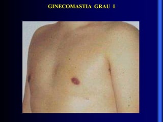 GINECOMASTIA GRAU I
 