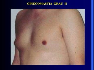 GINECOMASTIA GRAU II
 