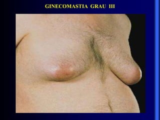 GINECOMASTIA GRAU III
 