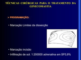 TÉCNICAS CIRÚRGICAS PARA O TRATAMENTO DA
GINECOMASTIA
 PROGRAMAÇÃO:
·Marcação Limites da dissecção
·Marcação incisão
·Infiltração de sol. 1:200000 adrenalina em SF0,9%
 