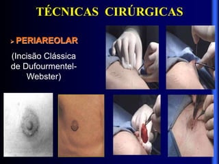 TÉCNICAS CIRÚRGICAS
 PERIAREOLAR
(Incisão Clássica
de Dufourmentel-
Webster)
 