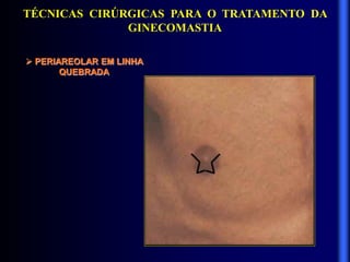 TÉCNICAS CIRÚRGICAS PARA O TRATAMENTO DA
GINECOMASTIA
 PERIAREOLAR EM LINHA
QUEBRADA
 