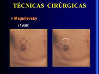 TÉCNICAS CIRÚRGICAS
 Maguilevsky
(1969)
 
