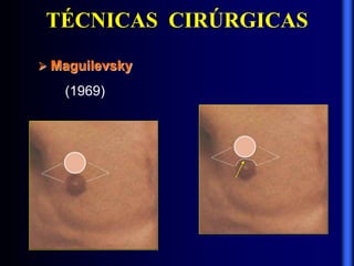 TÉCNICAS CIRÚRGICAS
 Maguilevsky
(1969)
 