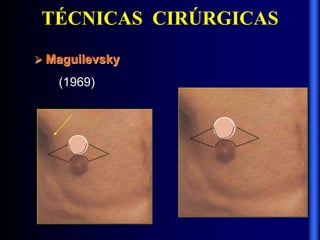 TÉCNICAS CIRÚRGICAS
 Maguilevsky
(1969)
 