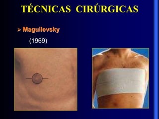TÉCNICAS CIRÚRGICAS
 Maguilevsky
(1969)
 