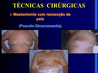 TÉCNICAS CIRÚRGICAS
 Mastectomia com ressecção de
pele
(Pseudo-Ginecomastia)
 