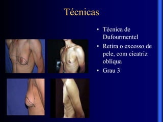 Técnicas
• Técnica de
Dufourmentel
• Retira o excesso de
pele, com cicatriz
oblíqua
• Grau 3
 