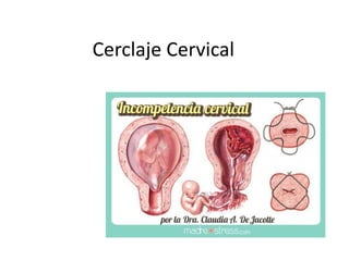 Cerclaje Cervical
 