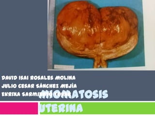 David Isai Rosales Molina
Julio Cesar Sánchez Mejía
Ekrixa Sarmiento Tovar

Miomatosis
uterina

 