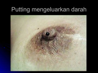 Putting mengeluarkan darahPutting mengeluarkan darah
 