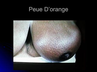 Peue D’orangePeue D’orange
 