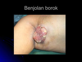 Benjolan borokBenjolan borok
 