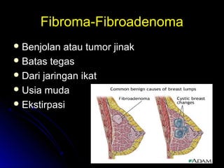 Fibroma-FibroadenomaFibroma-Fibroadenoma
 Benjolan atau tumor jinakBenjolan atau tumor jinak
 Batas tegasBatas tegas
 Dari jaringan ikatDari jaringan ikat
 Usia mudaUsia muda
 EkstirpasiEkstirpasi
 