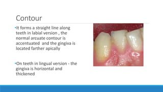 Contour
•It forms a straight line along
teeth in labial version , the
normal arcuate contour is
accentuated and the gingiva is
located farther apically
•On teeth in lingual version - the
gingiva is horizontal and
thickened
 