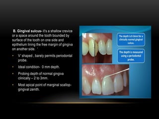 B. Gingival sulcus- it’s a shallow crevice
or a space around the tooth bounded by
surface of the tooth on one side and
epithelium lining the free margin of gingiva
on another side. ‘
• V’ shaped , barely permits periodontal
probe.
• Ideal condition- 0 mm depth.
• Probing depth of normal gingiva
clinically – 2 to 3mm.
• Most apical point of marginal scallop-
gingival zenith.
 