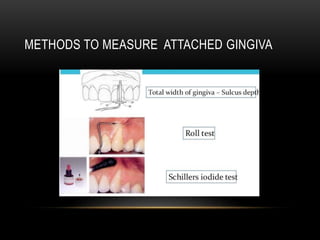 METHODS TO MEASURE ATTACHED GINGIVA
 
