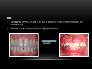SIZE:
• Corresponds with the sum total of the bulk of cellular and intercellular elements and their
vascular supply.
• Alteration in size is a common feature of gingival disease.
alteration
 