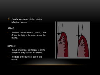  Passive eruption is divided into the
following 4 stages:
STAGE 1
• The teeth reach the line of occlusion. The
JE and the base of the sulcus are on the
enamel.
STAGE 2
• The JE proliferates so that part is on the
cementum and part is on the enamel.
• The base of the sulcus is still on the
enamel.
 