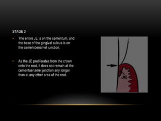 STAGE 3
• The entire JE is on the cementum, and
the base of the gingival sulcus is on
the cementoenamel junction.
• As the JE proliferates from the crown
onto the root, it does not remain at the
cementoenamel junction any longer
than at any other area of the root.
 