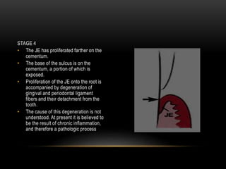 STAGE 4
• The JE has proliferated farther on the
cementum.
• The base of the sulcus is on the
cementum, a portion of which is
exposed.
• Proliferation of the JE onto the root is
accompanied by degeneration of
gingival and periodontal ligament
fibers and their detachment from the
tooth.
• The cause of this degeneration is not
understood. At present it is believed to
be the result of chronic inflammation,
and therefore a pathologic process
 