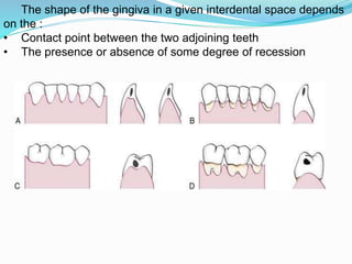 The shape of the gingiva in a given interdental space depends
on the :
• Contact point between the two adjoining teeth
• The presence or absence of some degree of recession
 