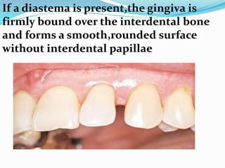 If a diastema is present,the gingiva is
firmly bound over the interdental bone
and forms a smooth,rounded surface
without interdental papillae
 
