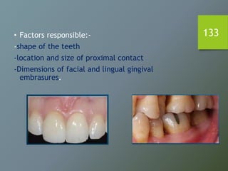 133• Factors responsible:-
-shape of the teeth
-location and size of proximal contact
-Dimensions of facial and lingual gingival
embrasures.
 