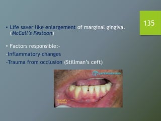 135• Life saver like enlargement of marginal gingiva.
(McCall’s Festoon)
• Factors responsible:-
-Inflammatory changes
-Trauma from occlusion (Stillman’s ceft)
 